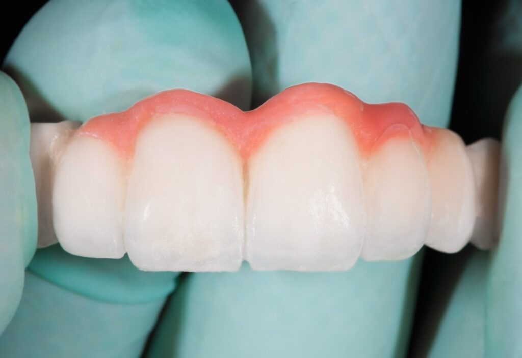 prototipul unei coroane dentare