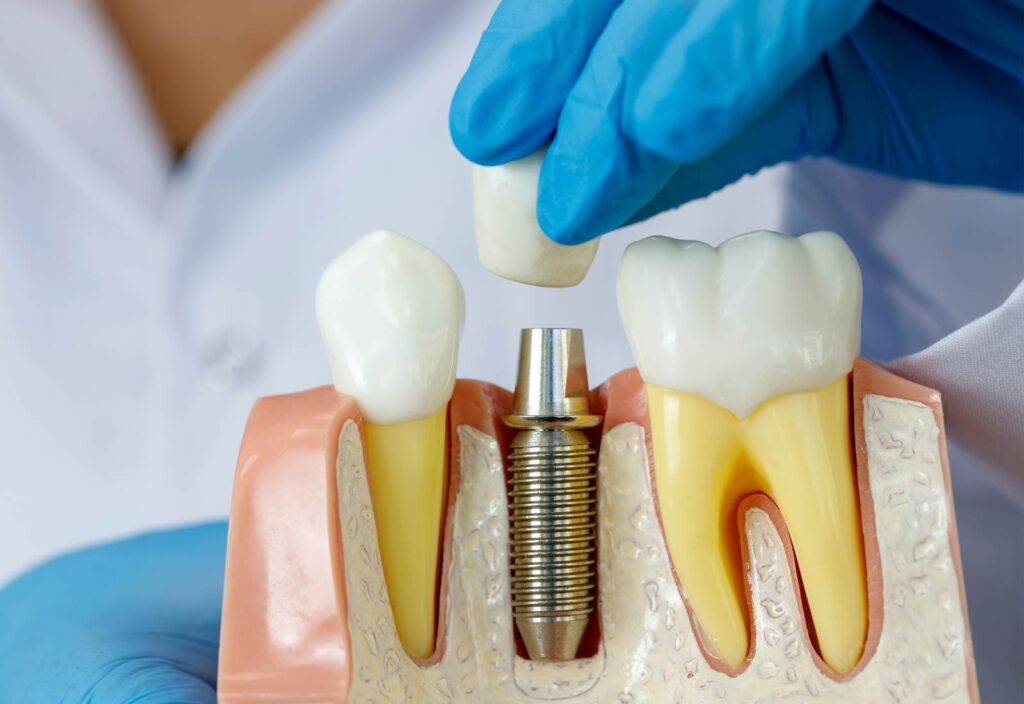 mulaj implant dentar