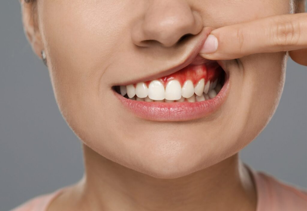 gingii inflamate în cazul parodontozei