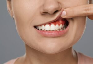 Gingii inflamate – din ce cauze apar și cum se tratează