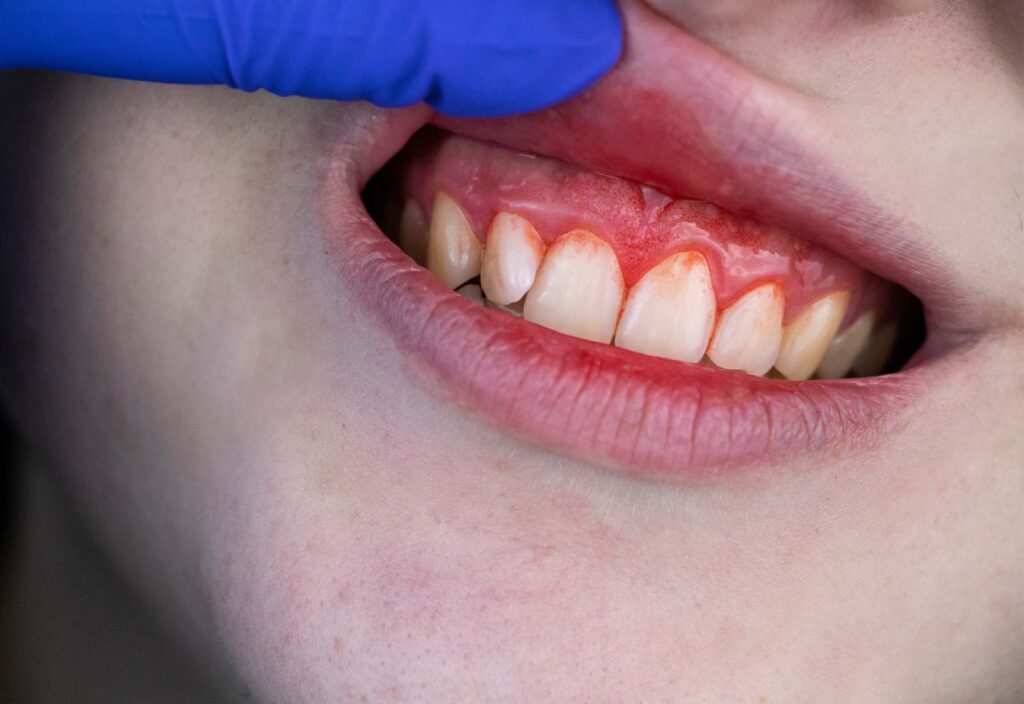 parodontita cu semne de sângerare a gingiilor