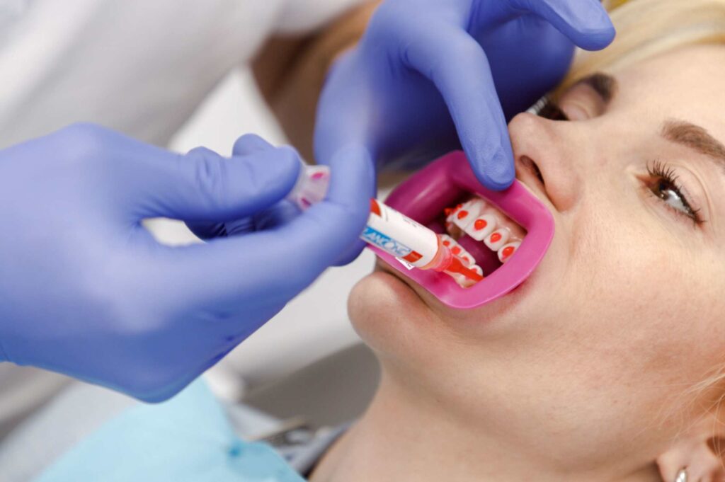 Soluții de tratament albire dinți pentru persoane cu dinți sensibili