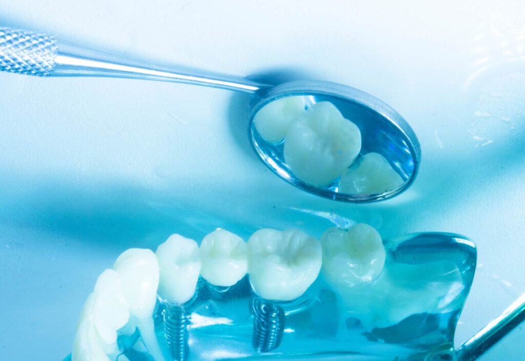 Care este riscul implantului dentar de a cădea și cum poate fi evitat acesta?