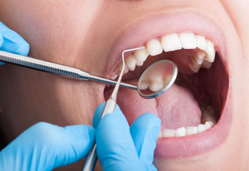 De ce apar cariile dentare în locuri inaccesibile și cum să le descoperi la timp?