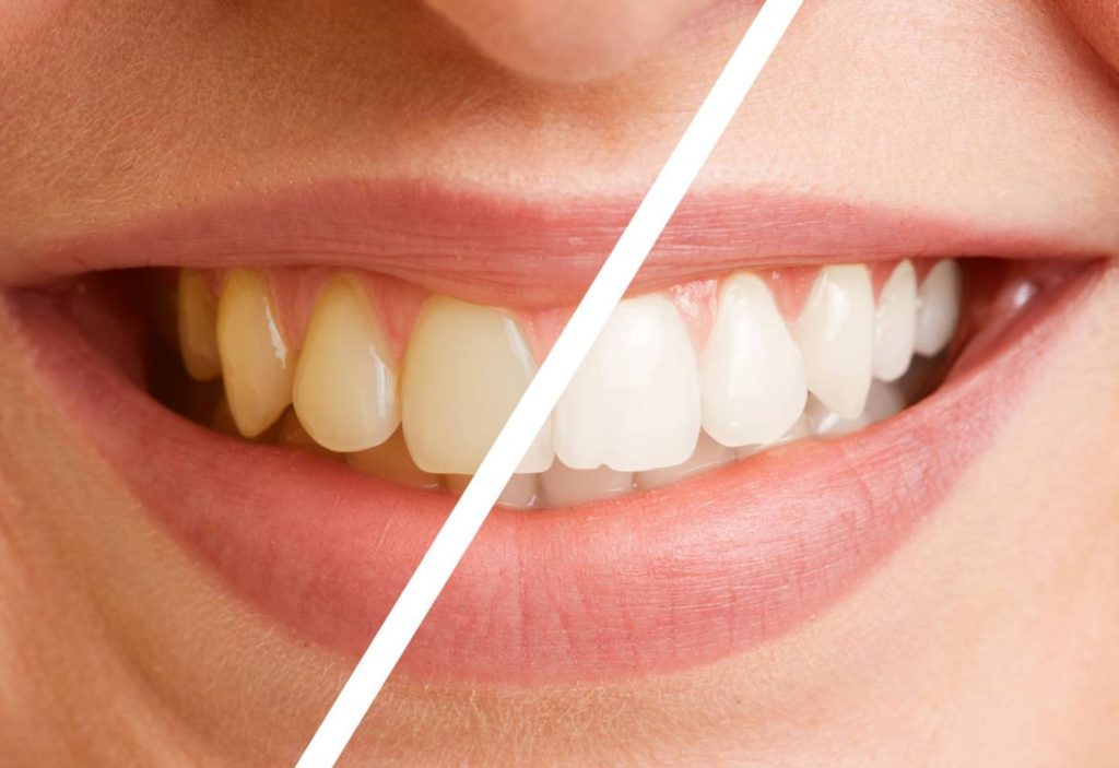 Cât de des trebuie să faci o curățare profesională de dinți și de ce nu e suficient periajul zilnic?