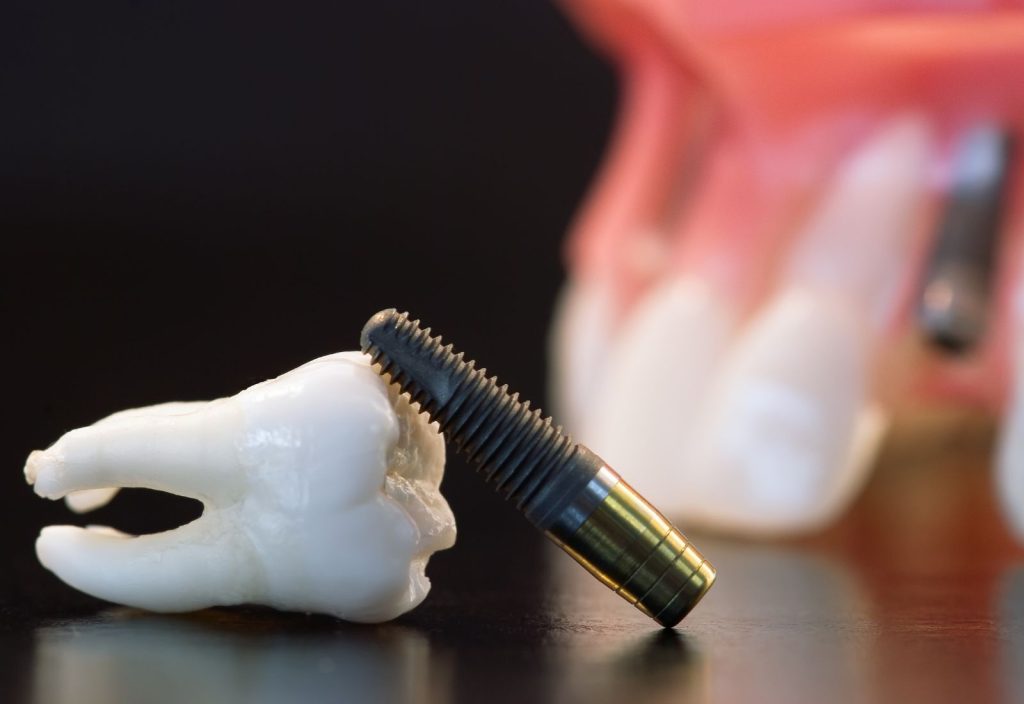 Implant măsea: ce trebuie să știi înainte, în timpul și după procedură