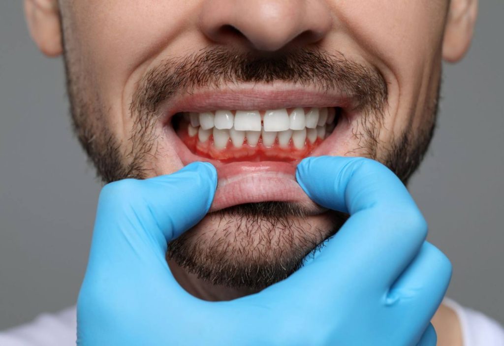 Ai sângerări gingivale? Un tratament parodontoză îți va salva dinții afectați