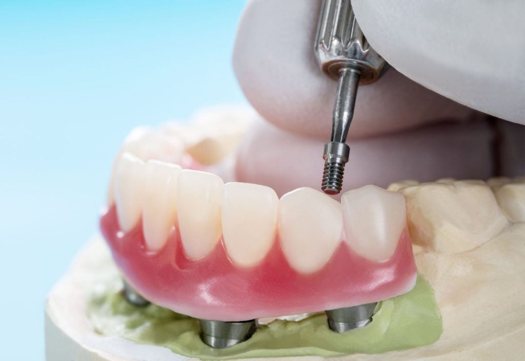 Proteza fixă cu 4 implanturi – soluție modernă pentru cei ce și-au pierdut toți dinții