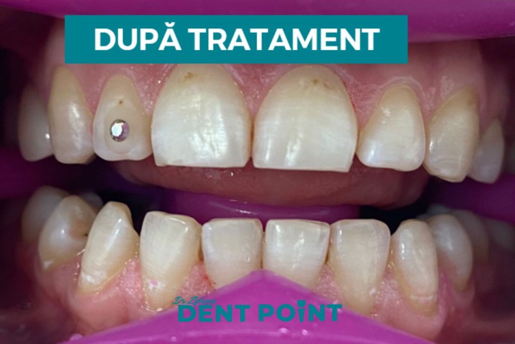 albire dentară după tratament