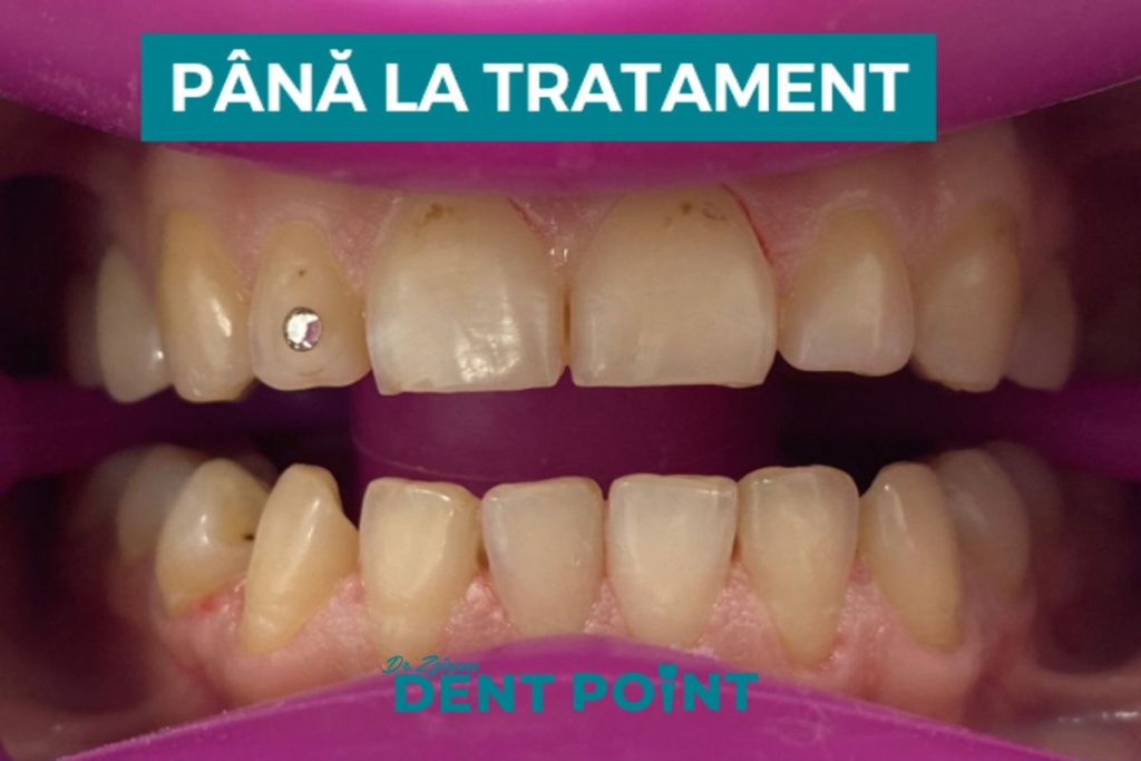 albire dentară până la tratament