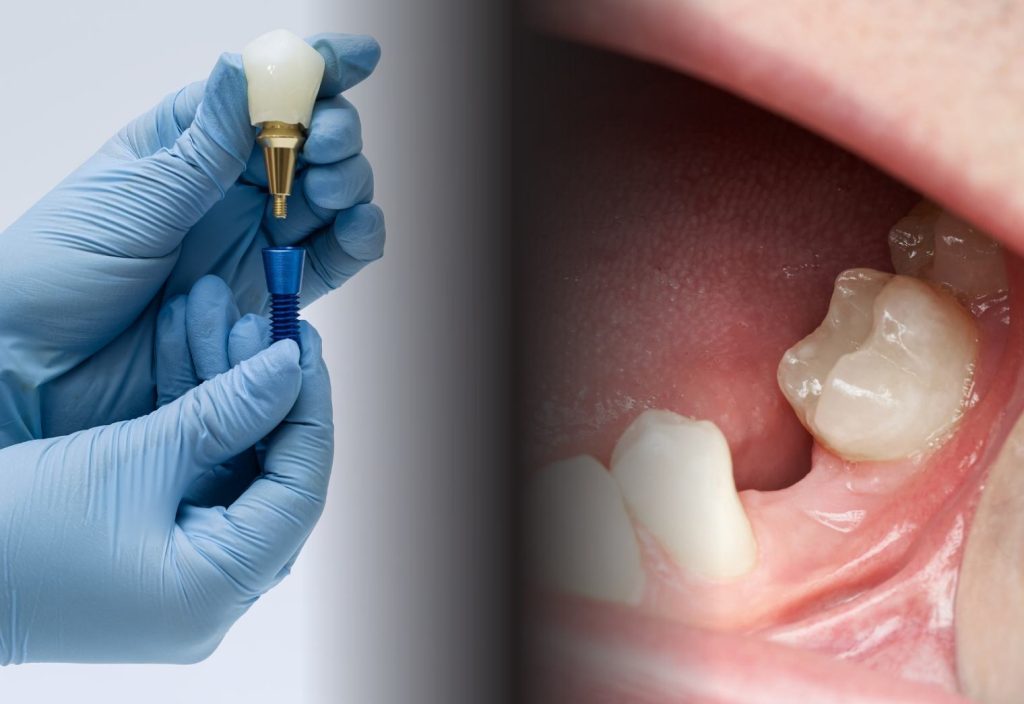 Riscuri implant dentar sau factori care influențează succesul tratamentului