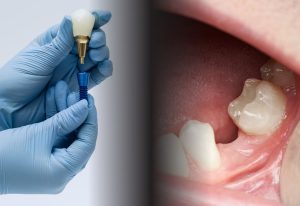 Riscuri implant dentar sau factori care influențează succesul tratamentului